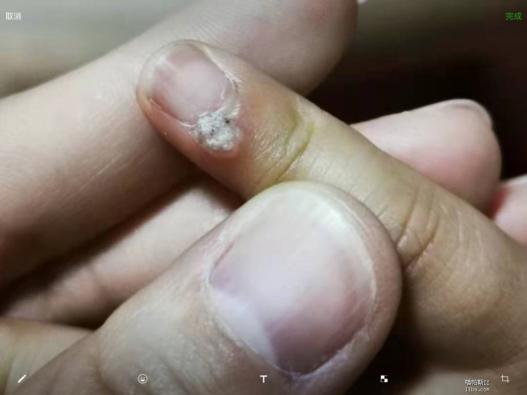 小朋友手指上长了个什么东西求助有图慎入