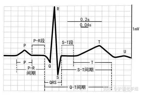 教你巧记心电图看完就能学会