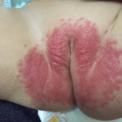 宝宝这几天外阴附近好红 这是怎麼回事?