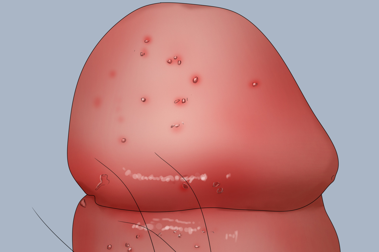 滴虫性包皮龟头炎图