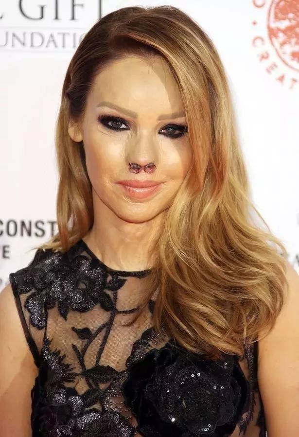 25岁毁容成怪物,左眼失明,31岁未婚生子,如今嫁对人的她却美到爆!