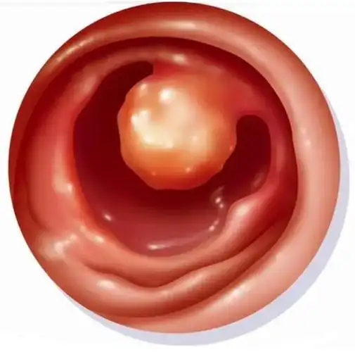 肛门息肉图和痔疮图片(女人外痔疮图片初期)