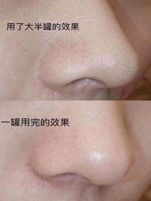 鼻子上黑头很严重毛孔粗大怎么办