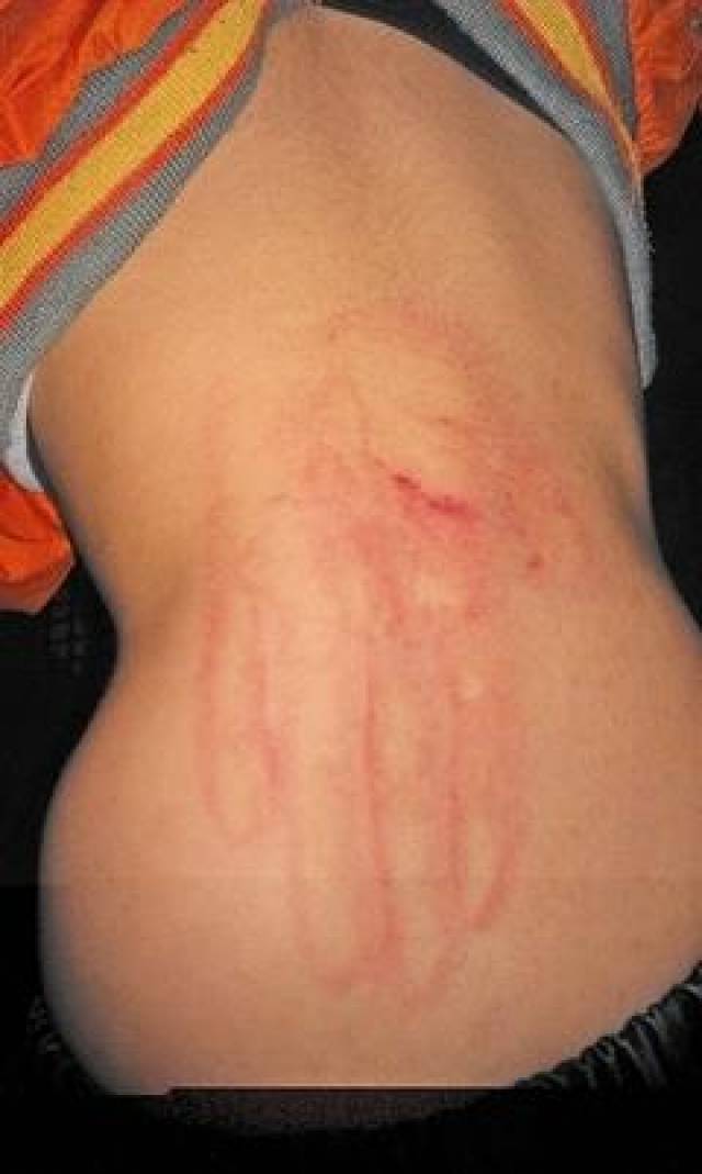 学校赔偿5万只因学生背上的巴掌印