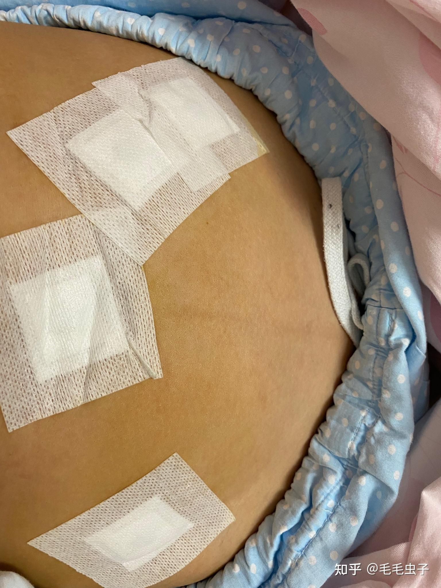 7cm子宫肌瘤腹腔镜手术记录-已出院补充术后情况 - 知乎