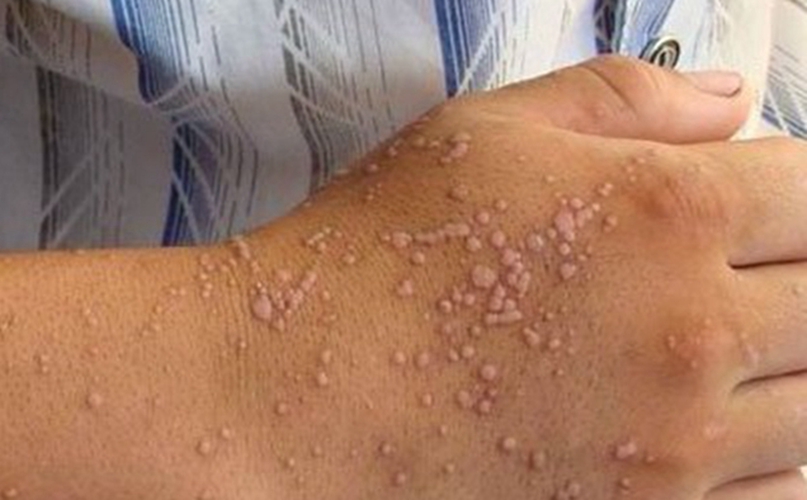 手背扁平疣初期图片