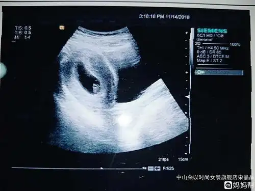 而且怀孕42的时候最准了我就是在42天的时候做出来的男孩;1  孕囊看