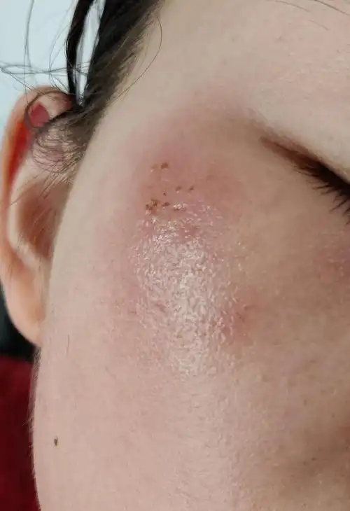 求帮忙看看面部湿疹半边脸肿起来