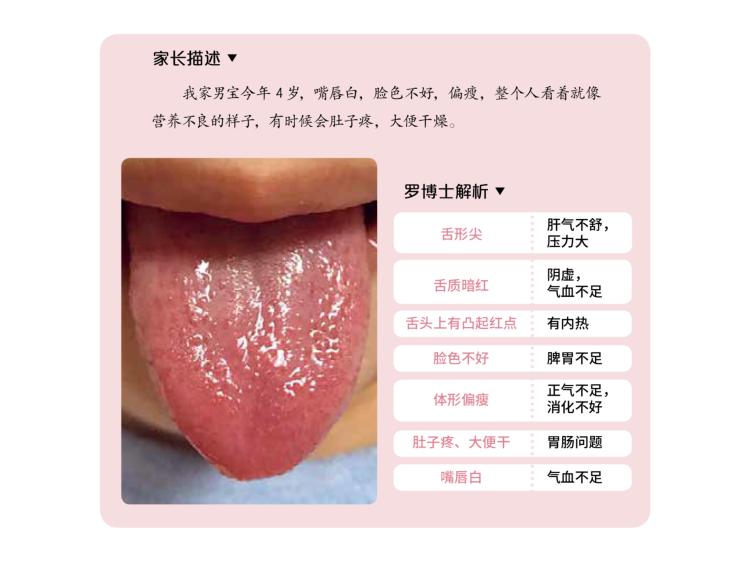 图解儿童舌诊40:肝气不舒的孩子也会伤阴