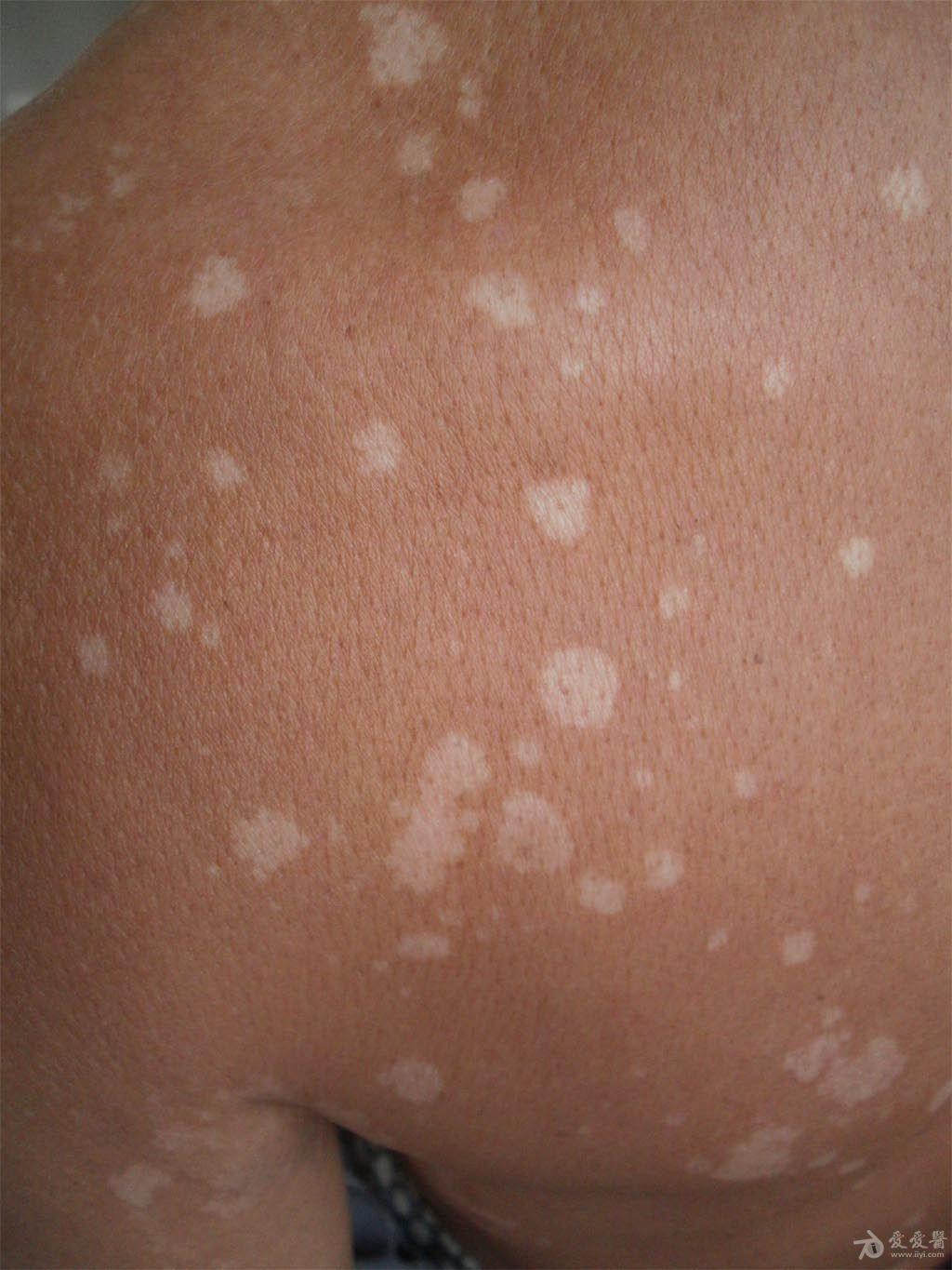 花斑癣一例. - 皮肤及性传播疾病讨论版 - 爱爱医医学论坛