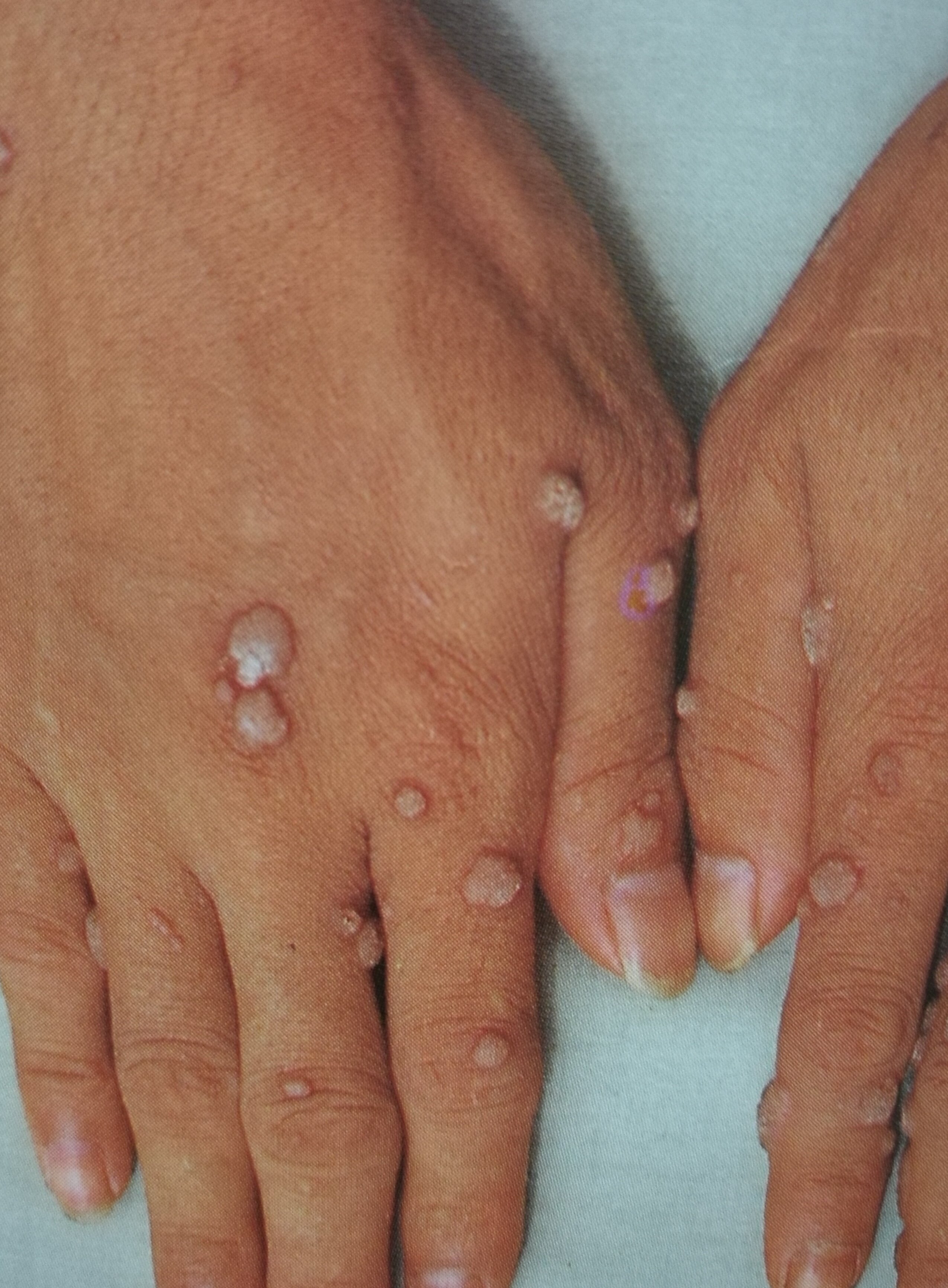 得了病毒疣不要急,看了这篇文章就清楚了