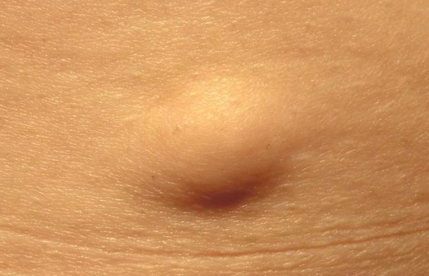 35岁女子,后背长了一个包块,洗澡的时候挠出血,到县医院检查,误诊脂肪