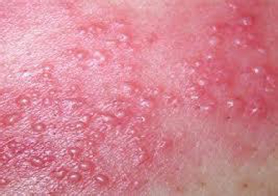 性病性淋巴肉芽肿套图 (46)_有来医生