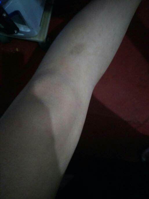 膝盖这里凹进去了,之前有点痛,走路不痛,就是跪的时候痛,现在好一些了