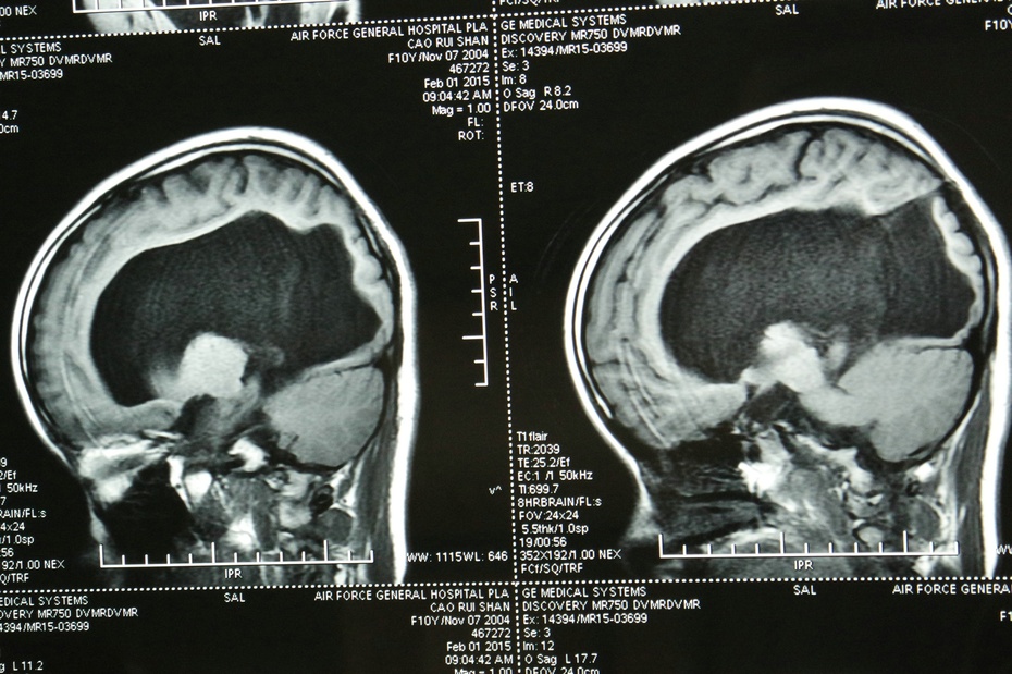 临床小儿多见头颅增大,囟门扩大,紧张饱满,颅缝开裂愈期不合,落日目