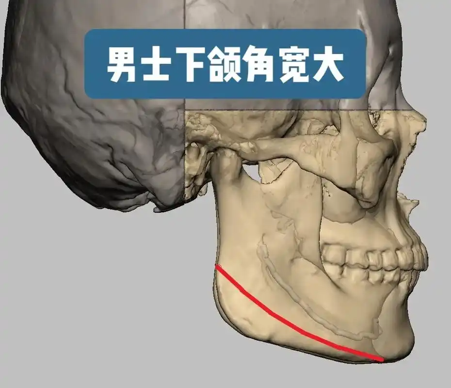 看脸的时代,男士也有下颌角截骨的需求.这位患 - 抖音