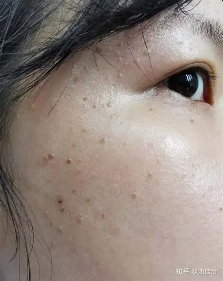 扁平疣图片和初期症状图片