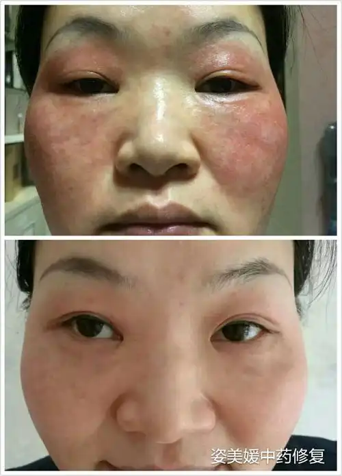 过敏激素皮炎红血丝的全面解析——姿美媛中药问题皮肤修复