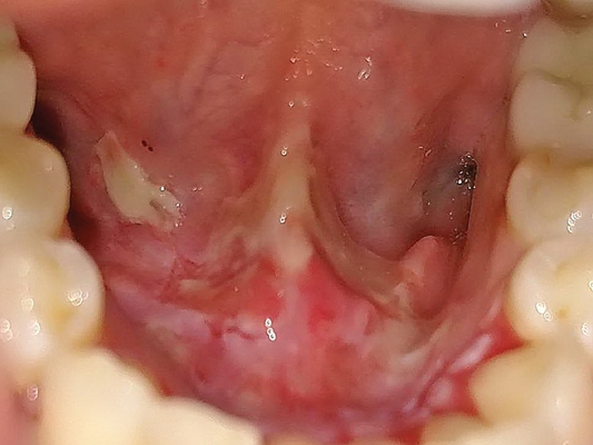 咽部肿瘤图片_咽部肿瘤症状表现图片大全_有来医生
