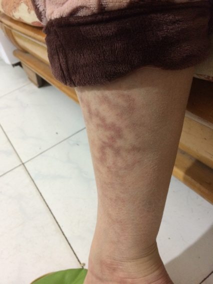 其他2条回答  2015-03-05 21:33   热心网友  是不是烤火烤出来的