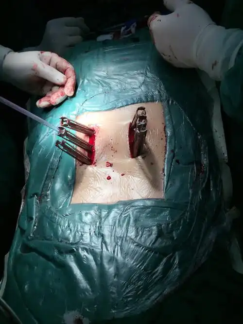 院脊柱外科再次完成一例经皮微创双节段腰椎融合并椎间盘摘除减压手术