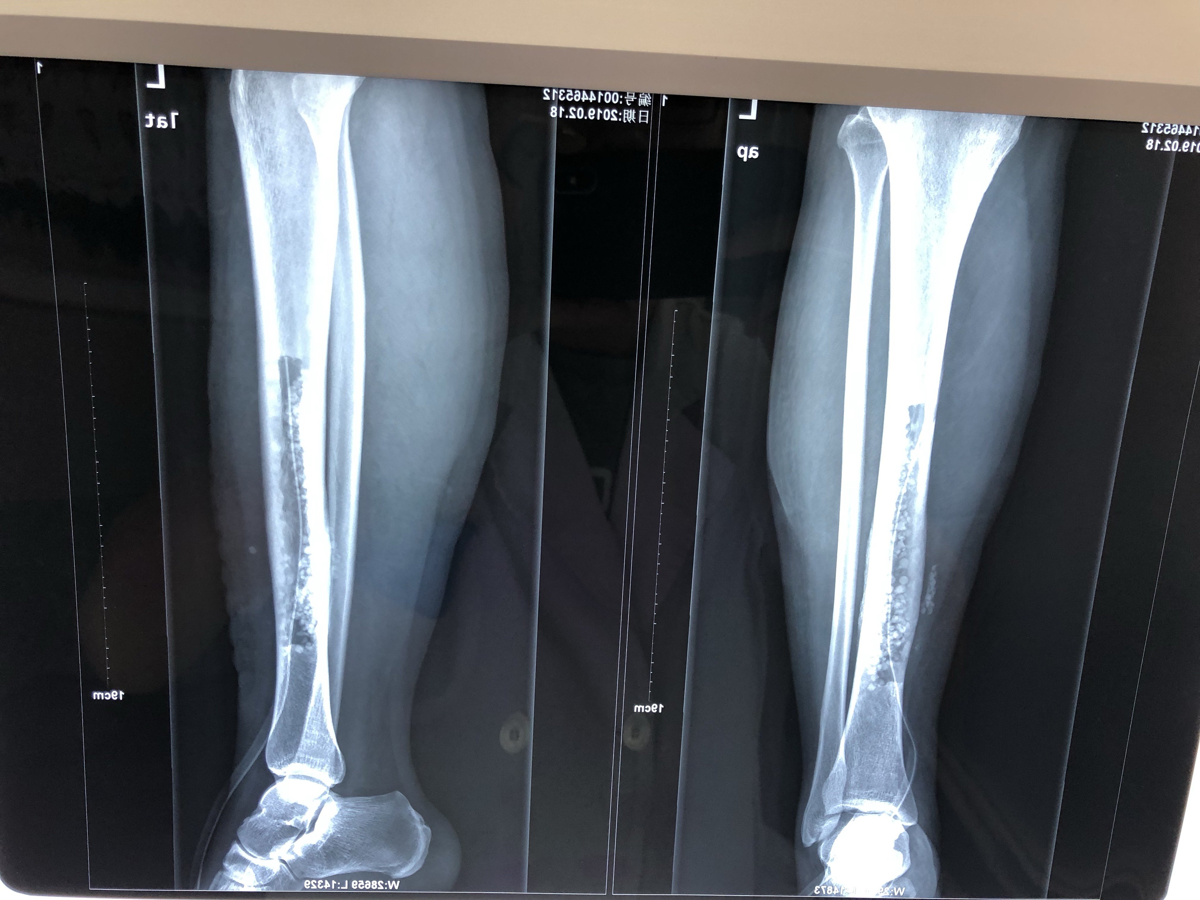 下肢骨髓炎患者,下肢痛,行下肢骨水泥植入治疗 - 好大夫在线