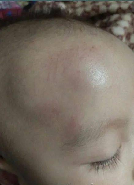 "宝宝头摔出一个鼓包,会伤到脑子吗?要不要做ct?_孩子头