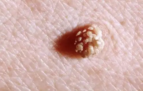 男性尖锐的前兆照片