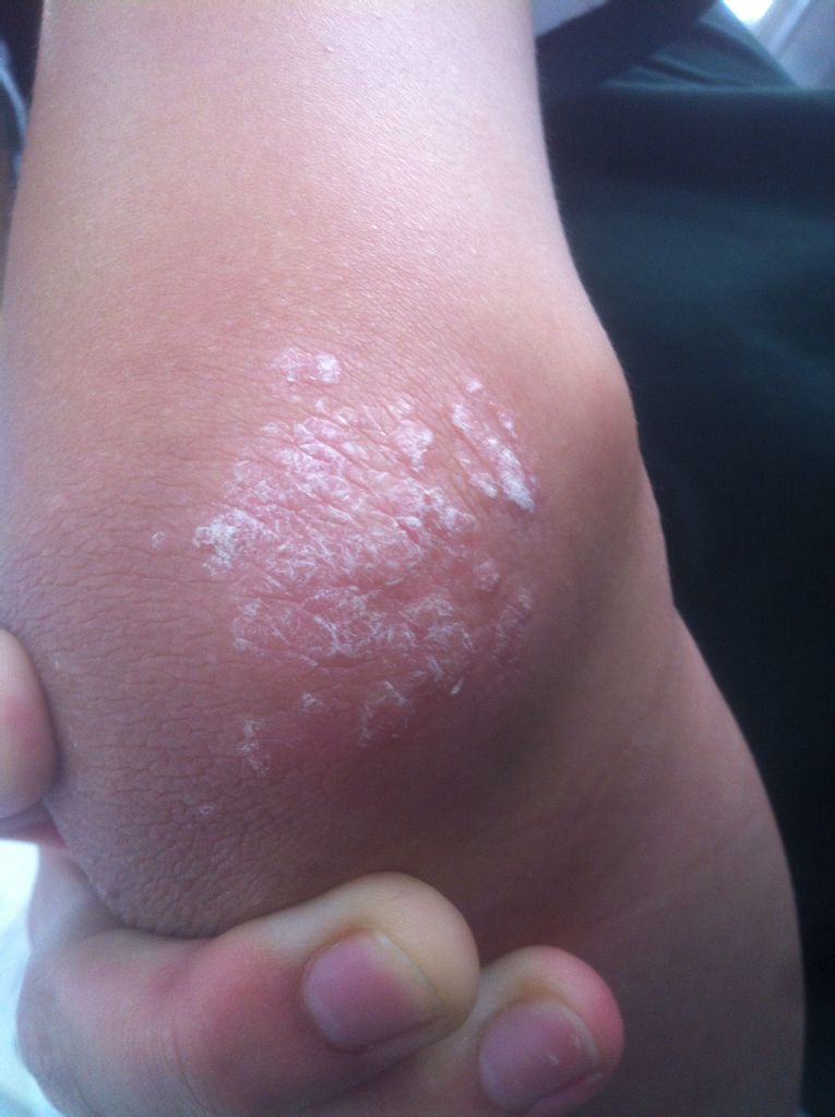 手肘处这是什么症状?