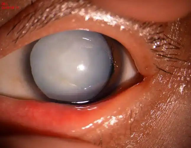 散瞳后,晶状体乳白色混浊,视力只有眼前手动.