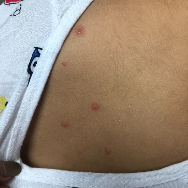 头上背上都长了像水痘一样的东西,破了有水,不痛不痒,请问是什么病症?