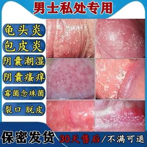 霉菌性龟头炎治疗包皮炎消炎膏红白点肿阴囊潮湿脱皮裂口专用药膏