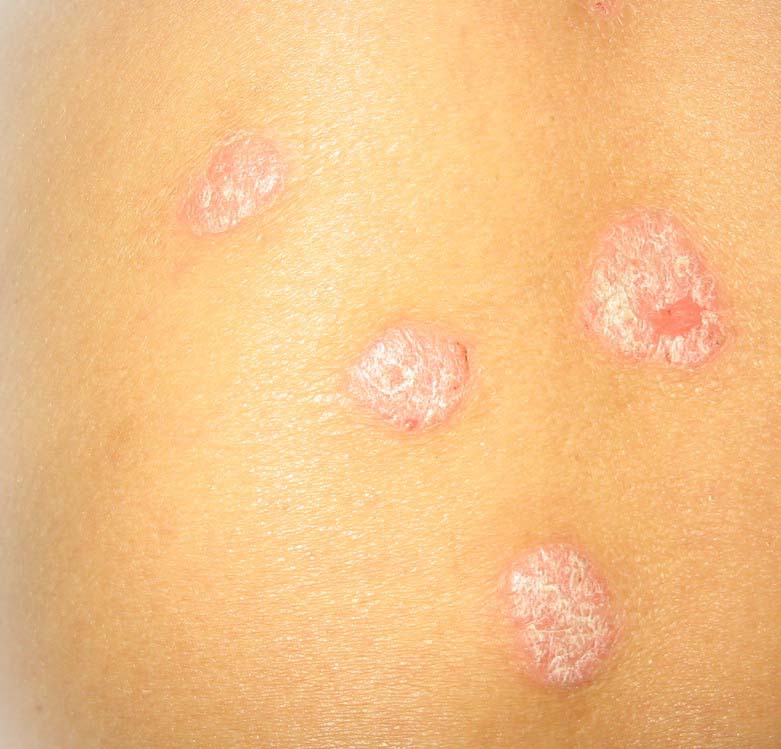 寻常型牛皮癣词条图册_百度百科