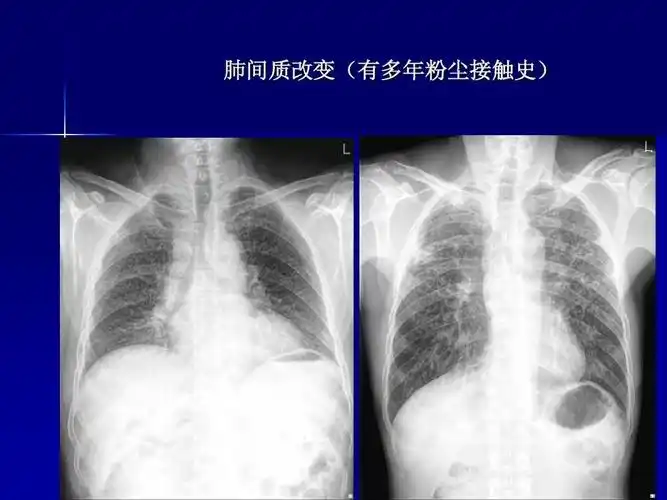 x线胸片阅读基础ppt