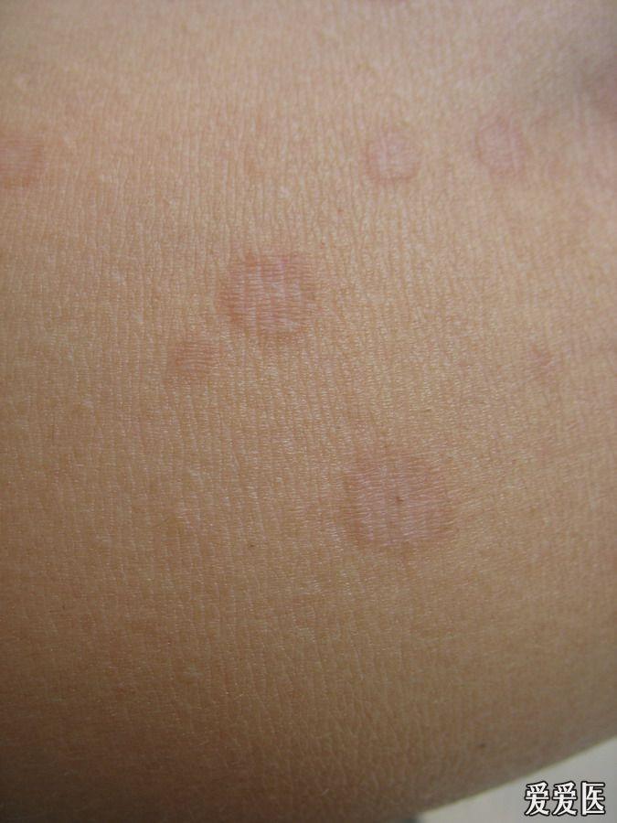 这个皮肤病是花斑癣吗