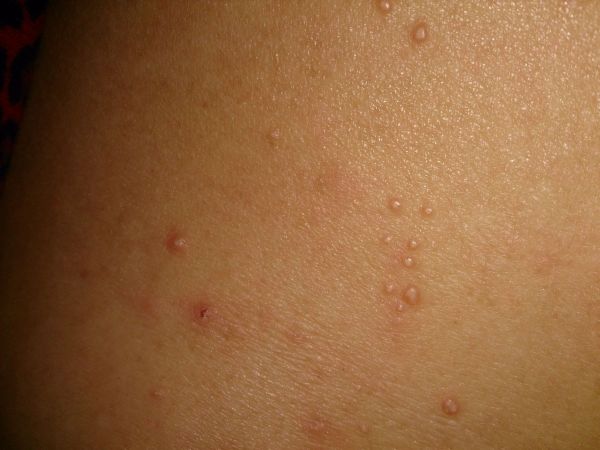 背部长了很多疙瘩,白色的,时间大概1年左