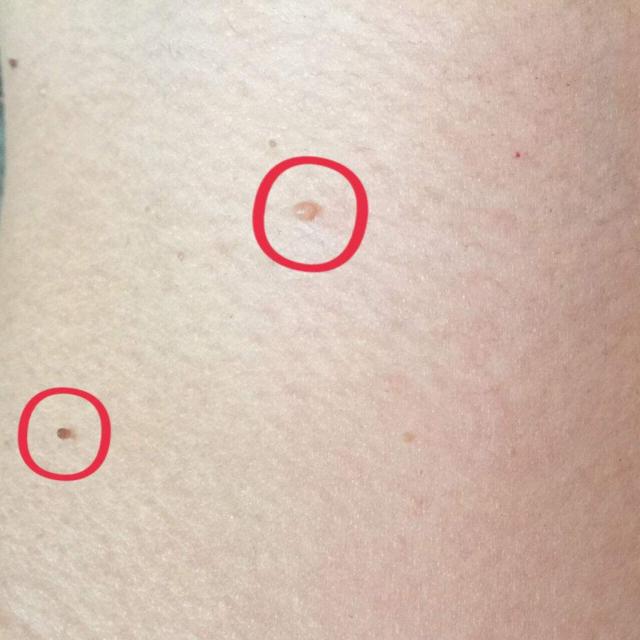 脖子上长出了"小肉粒",别只顾影响美观,当心也会