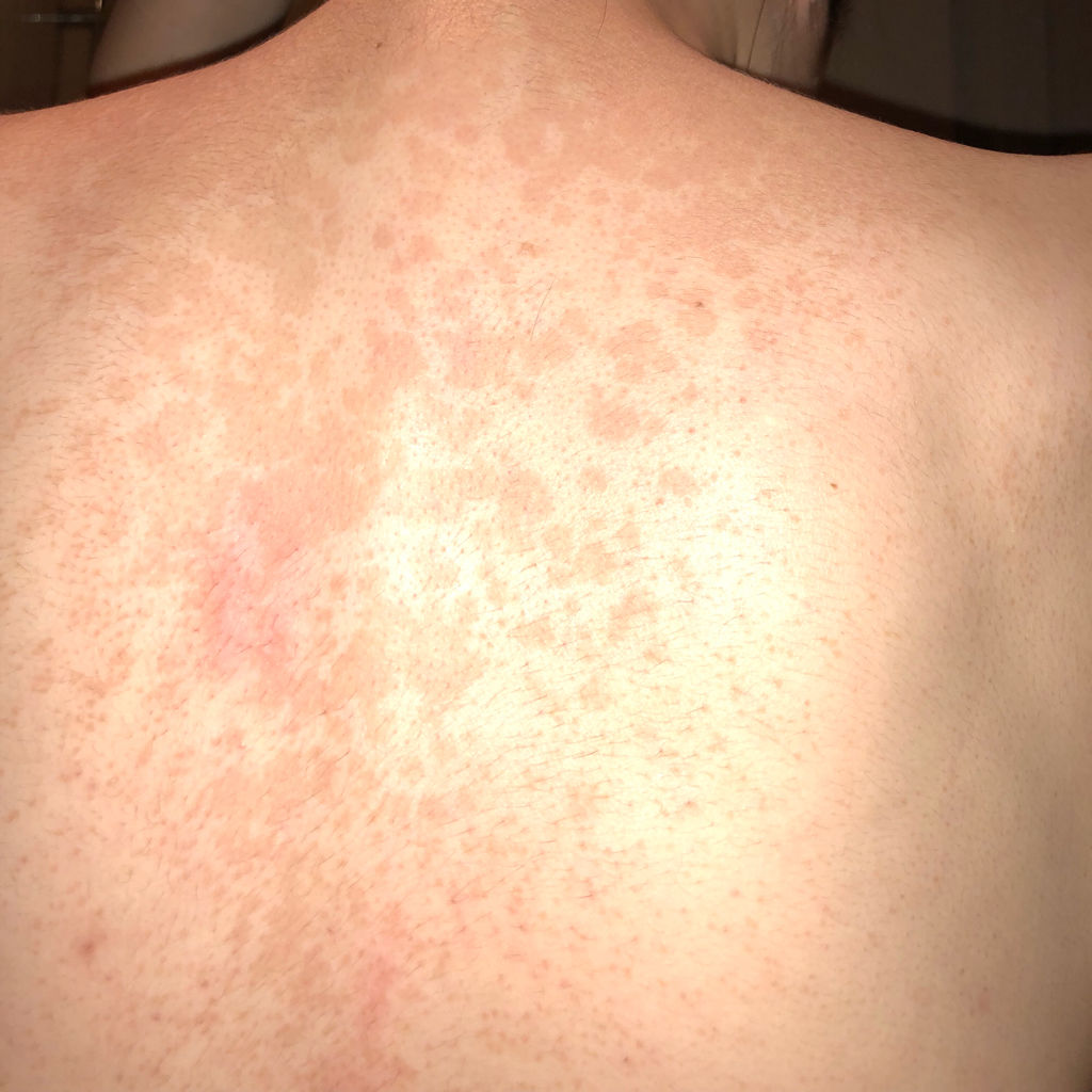 背上长满斑数月 这几天越来越明显和增多这是什么斑