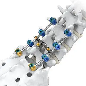 胸腰骶椎脊柱内固定系统 / 后入路