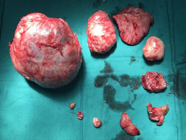 女学生子宫肌瘤多如"糖葫芦" ,开腹手术艰险摘除!