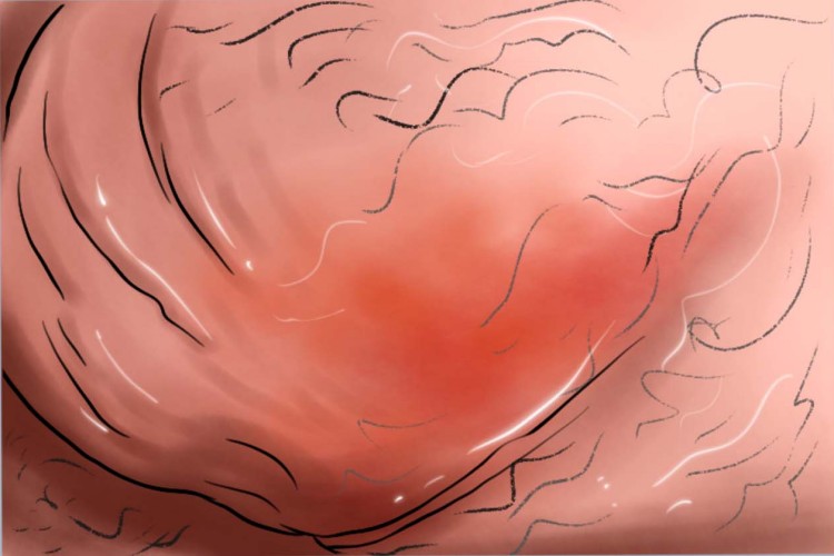 阴囊丹毒:起病急,进展快,伴有全身中毒症状.