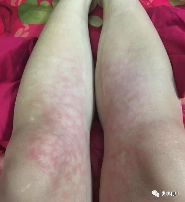 她说:最近天天用小太阳取暖器烤火,没想到烤成这样,这么多火斑子,怎么