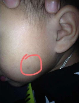 小孩脸上起黑点是怎么回事
