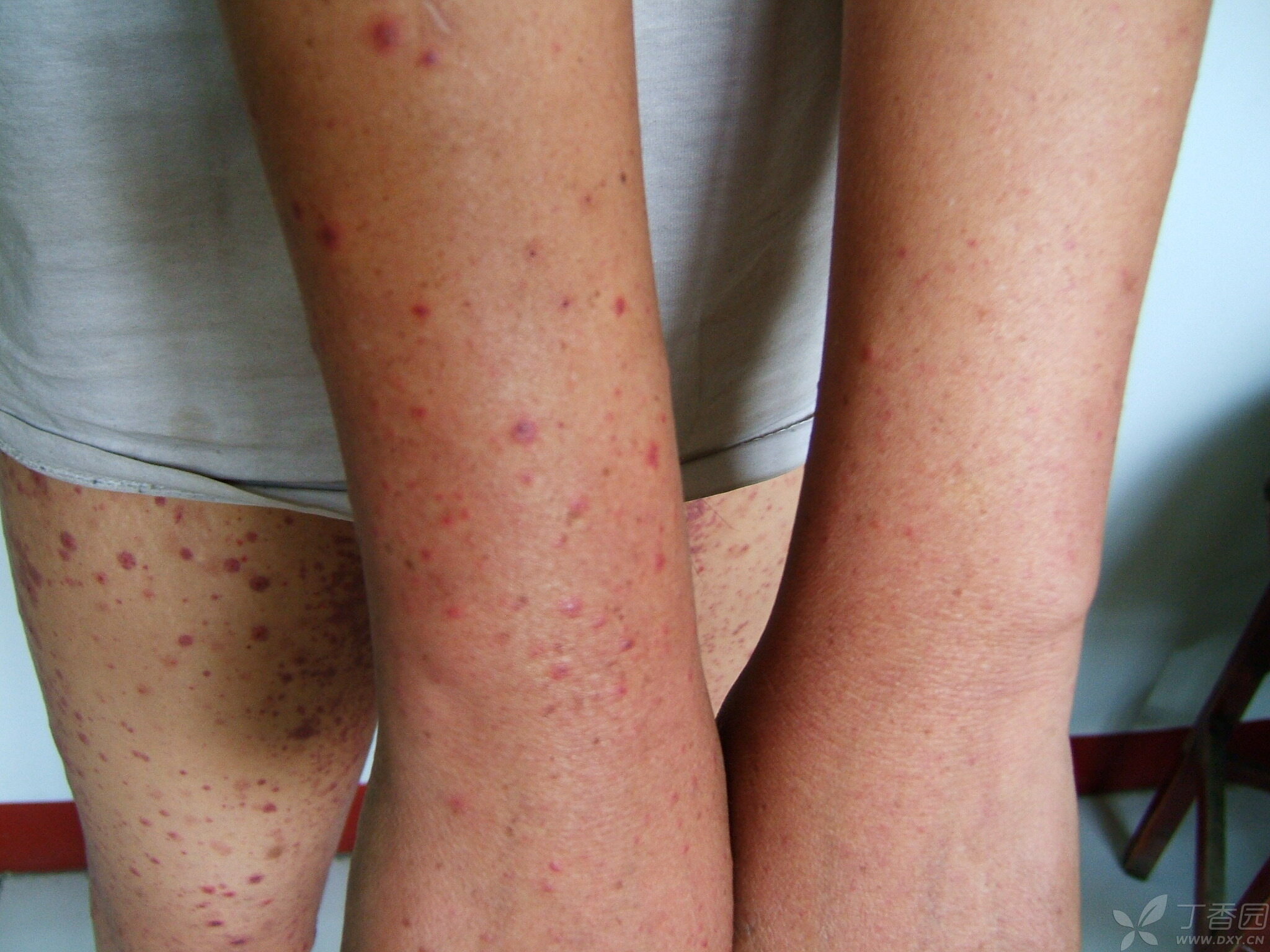 【请教】变应性血管炎还是过敏性紫癜