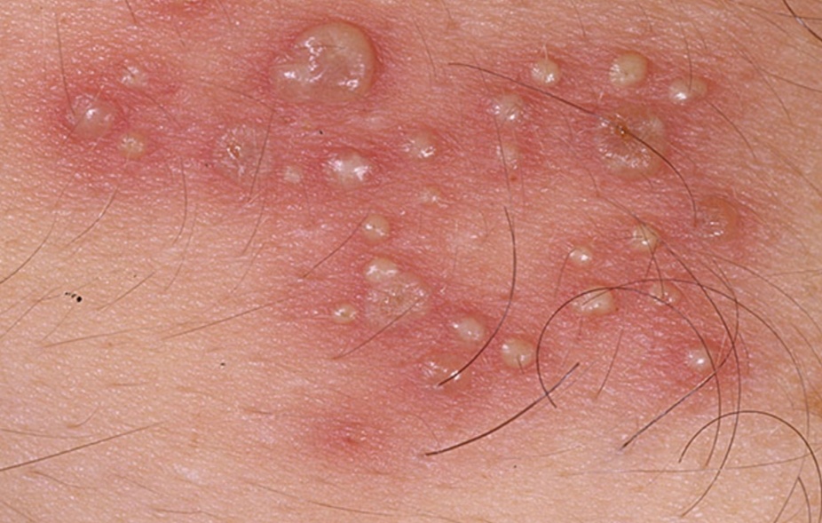 无症状hsv2携带者,会传播生殖器疱疹吗?