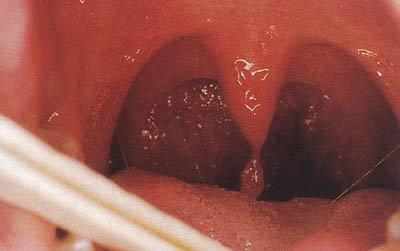 小舌头长了这个东西 我感觉像是不小心割破了小舌头