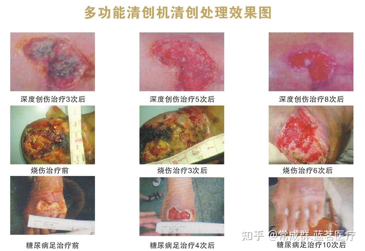 为什么超声清创系统可以提高清创效率