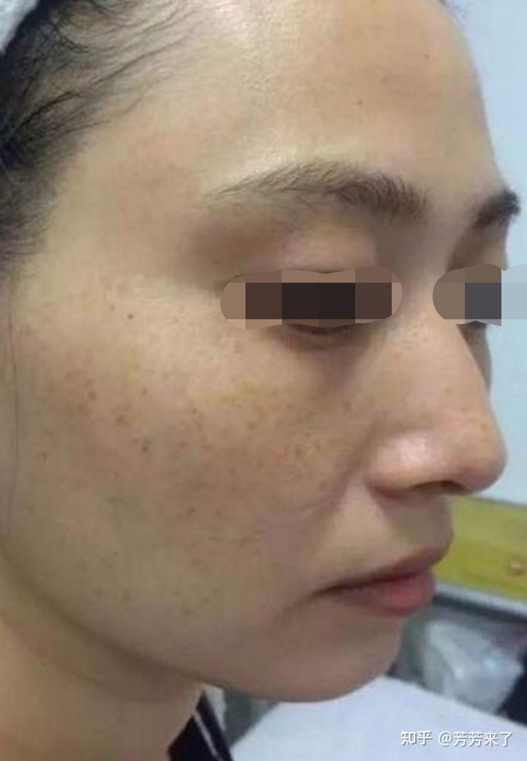 黄褐斑与雀斑的区别? - 知乎