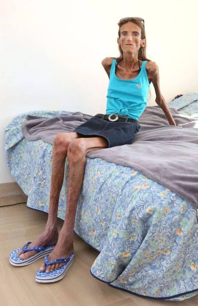 最轻的时候体重只有25公斤左右,一度被称为是"世界上最瘦的女人"