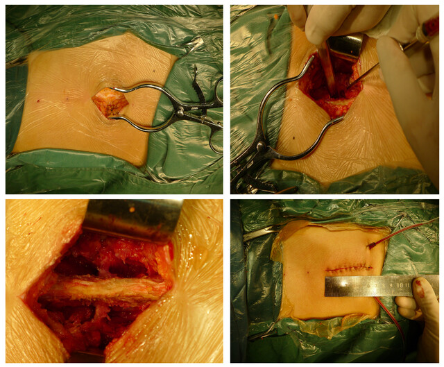 腰椎间盘突出症手术发展史:何谓微创手术?